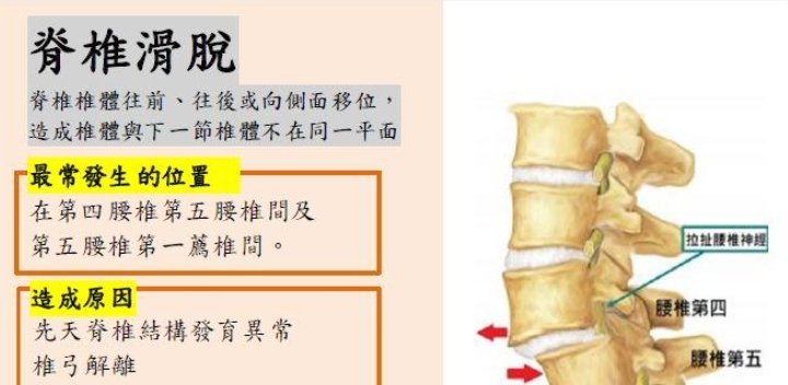 衛生福利部新營醫院-脊椎滑脫